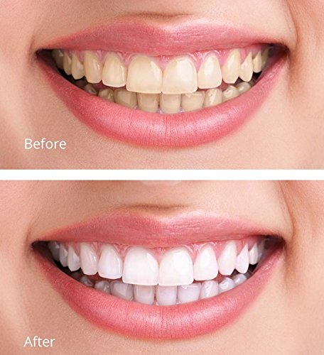 White Teeth Global 44% Carbamide Peroxide Teeth Whitening Gel Kit โ 10 Syringes, 2 Trays, Shade Guide | At-Home Whitening