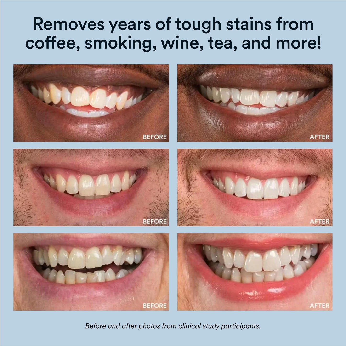 Auraglow Teeth Whitening Kit with LED Light โ 35% Carbamide Peroxide, 20 Treatments