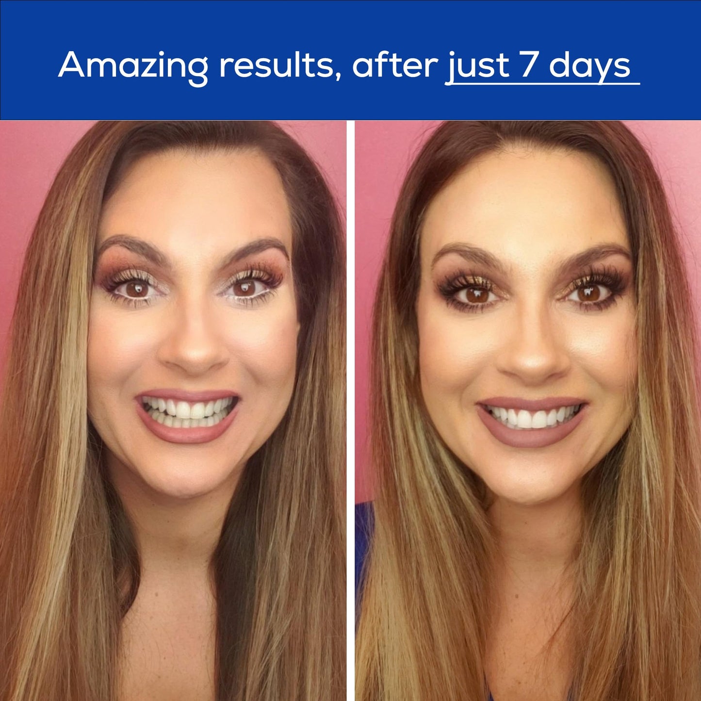 GLO Science Teeth Whitening Gel โ 6% Hydrogen Peroxide, 10 Gel Vials + Lip Care