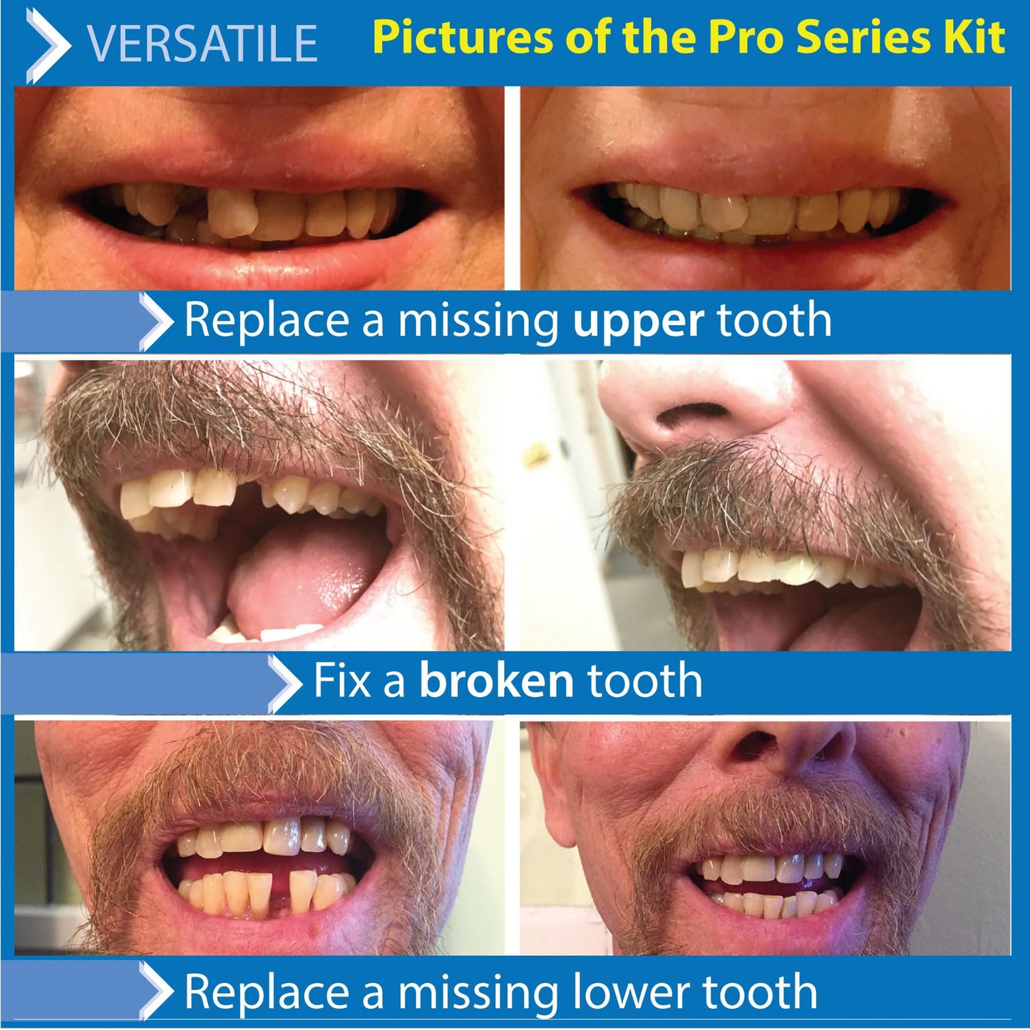 Instant Smile Pro Series Temporary Tooth Kit โ At-Home Replacement