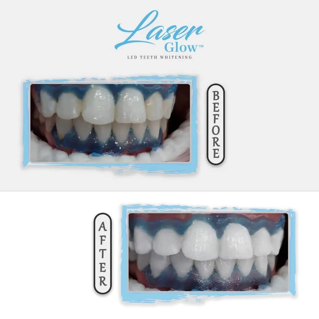 LaserGlow Professional Teeth Whitening Gel 44% Hydrogen Peroxide โ Dual Barrel Syringe