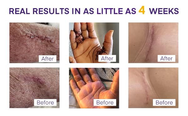 MURASAKI BEAUTY Silicone Scar Gel SPF 30 โ Medical-Grade Scar Cream (1.06oz)