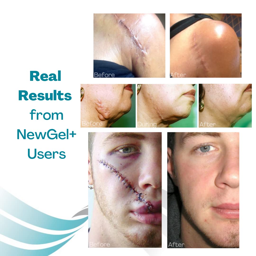 MyNewGel Advanced Silicone Scar Sheets โ 1 x 6 inch, 4 Count, CLEAR