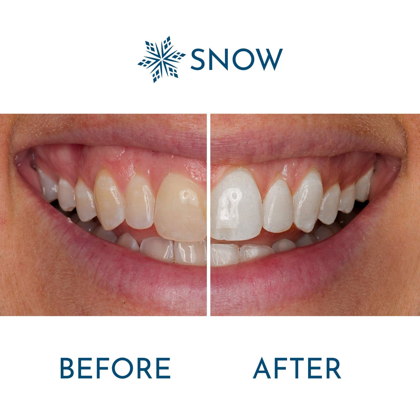 Snow Extra-Strength Teeth Whitening Serum – Whitening Pen with Potassium Nitrate & Hydroxyapatite – 1 Pack
