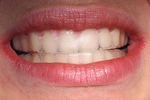 Teeth Whitening Tray Ultra White โ 0.75mm Ultra Thin Moldable Trays with Storage Case