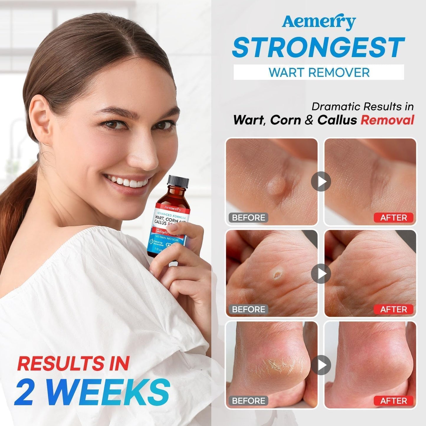 Aemerry Wart Corn Callus Remover – Maximum Strength Liquid Salicylic Acid for Feet (30ml)