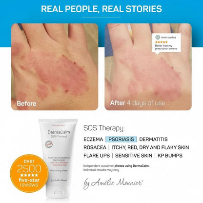 Amélie Monnier Clinically Tested DermaCalm SOS Therapy – Eczema & Dry Skin with Urea 8%, Probiotics