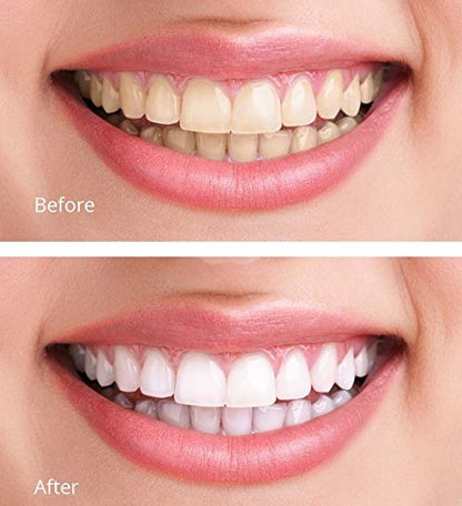 White Teeth Global 44% Carbamide Peroxide Teeth Whitening Gel Kit – 10 Syringes, 2 Trays, Shade Guide | At-Home Whitening