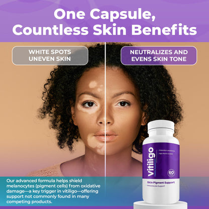 Aura Vitamins Vitiligo Capsules – 60 Count | Pigmentation Support & White Spots