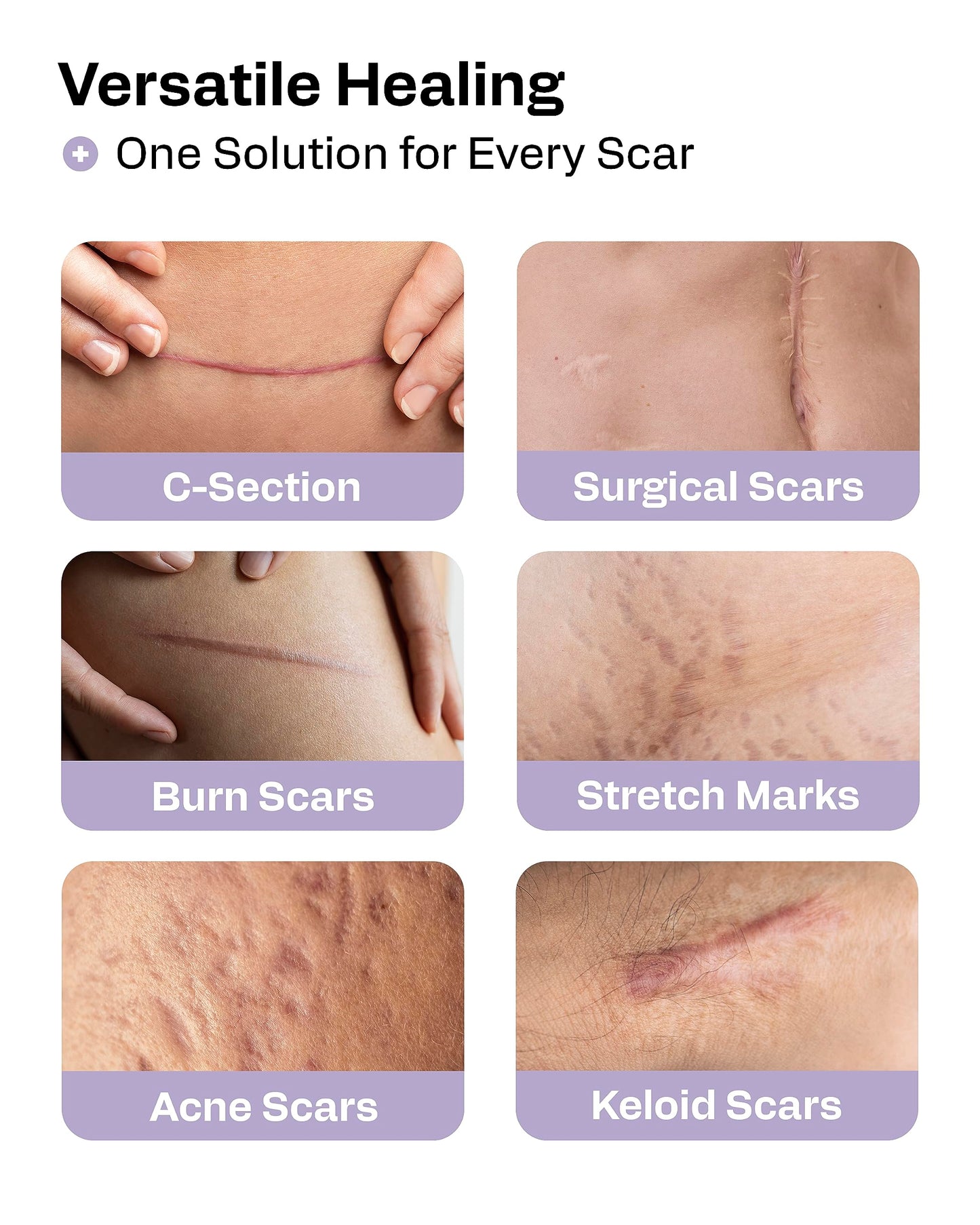 AWD Silicone Scar Tape Roll 60in – Medical-Grade Scar Tape for Surgical Scars, C-Section, Tummy Tuck, Reusable Scar Sheets
