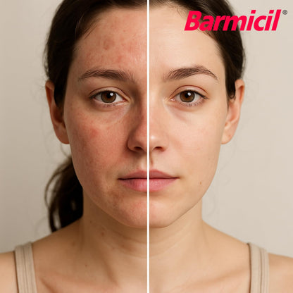 Barmicil Plus Cream 1% Hydrocortisone – Itch Relief for Skin Allergies with Aloe Vera