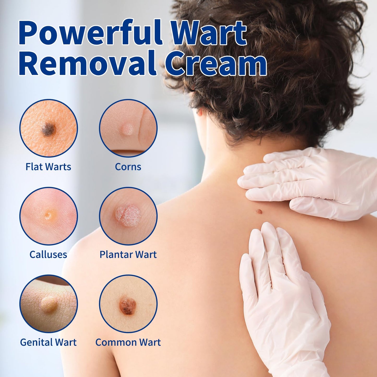 Bighero Wart Fast Acting Cream – High-Strength Wart Care (17% Salicylic Acid) | NDC 84010-047-01