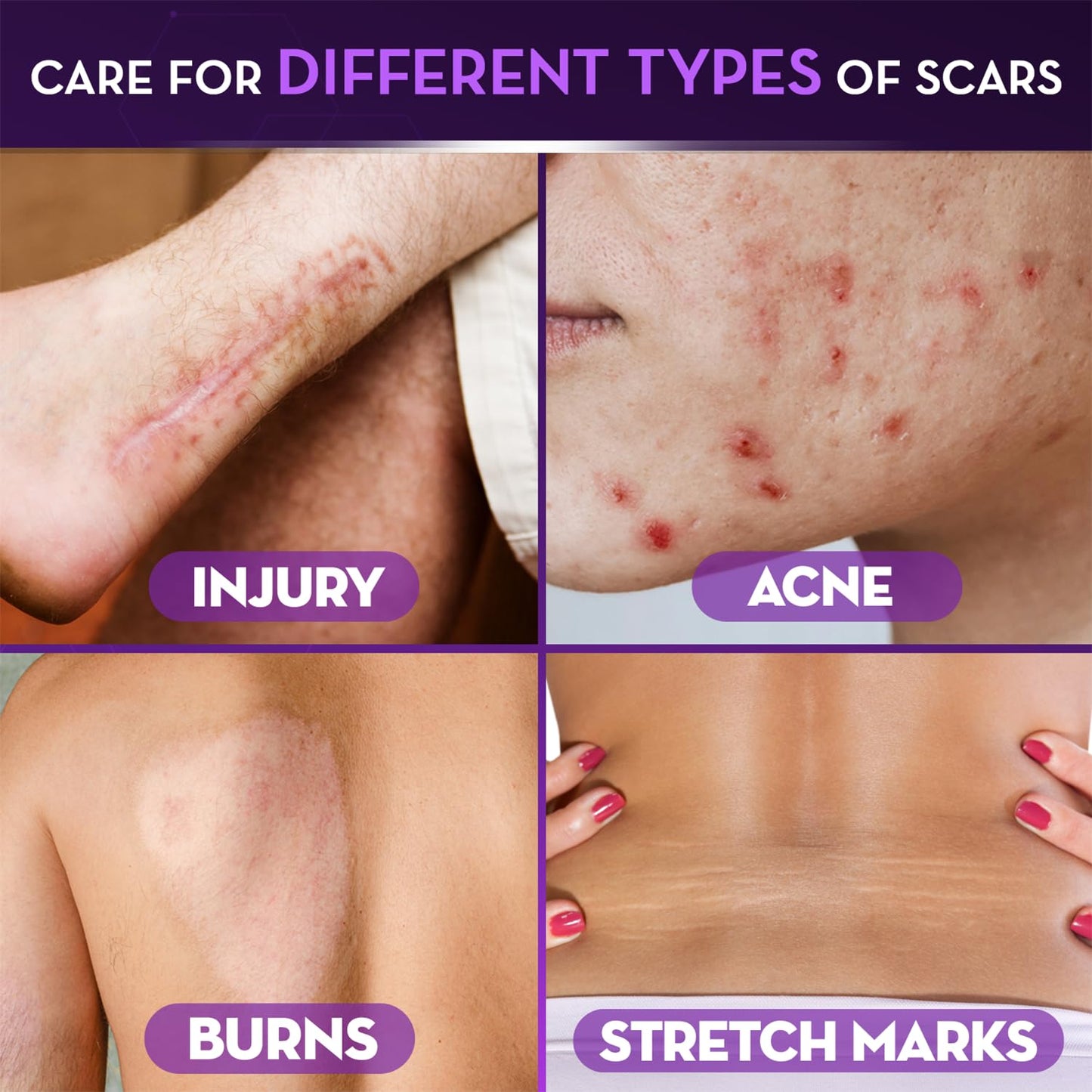 Cicatricure Advanced Scar Gel for Face & Body – Visible Results in 2 Weeks
