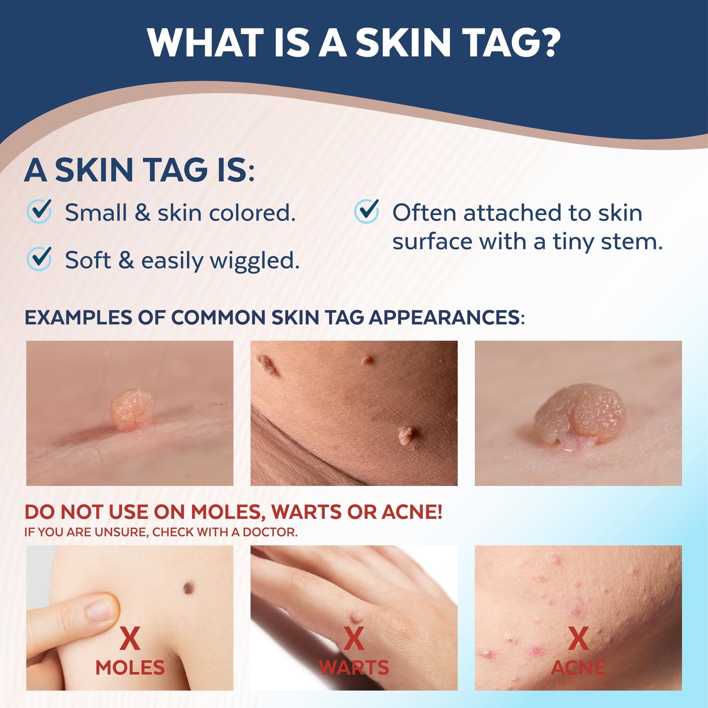 Claritag Advanced Skin Tag Remover - FDA-Cleared At-Home Skin Tag Removal (7-14 Days)
