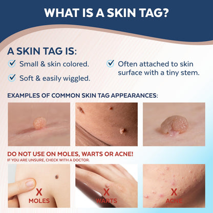 Claritag Advanced Skin Tag Remover - FDA-Cleared At-Home Skin Tag Removal (7-14 Days)
