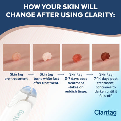 Claritag Advanced Skin Tag Remover - FDA-Cleared At-Home Skin Tag Removal (7-14 Days)