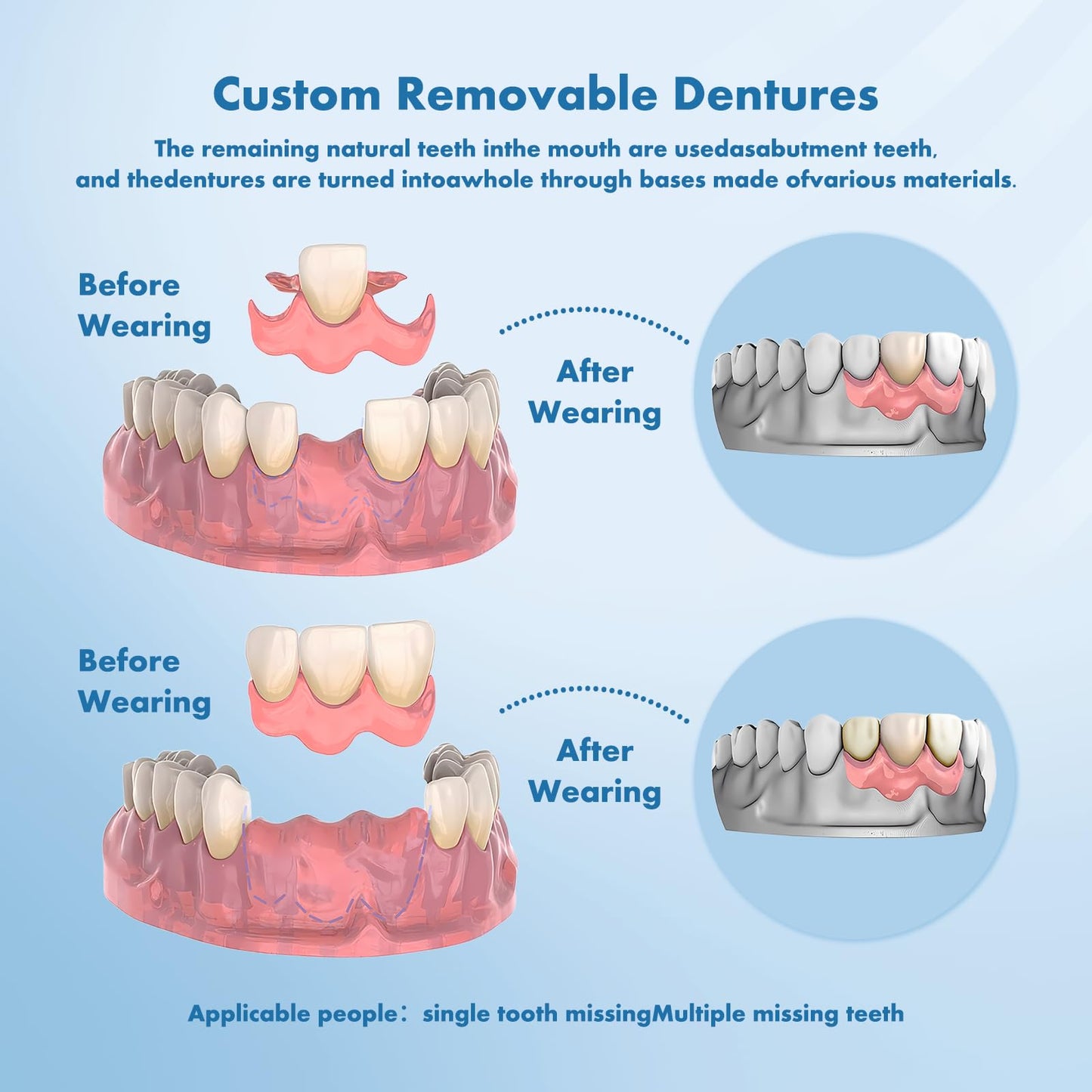 Custom Removable Dentures – Personalized Partial Denture Set for Tooth Replacement | 1–Multi-Tooth Coverage with Storage Case | Comfortable Wear for teeth (5 Teeth)