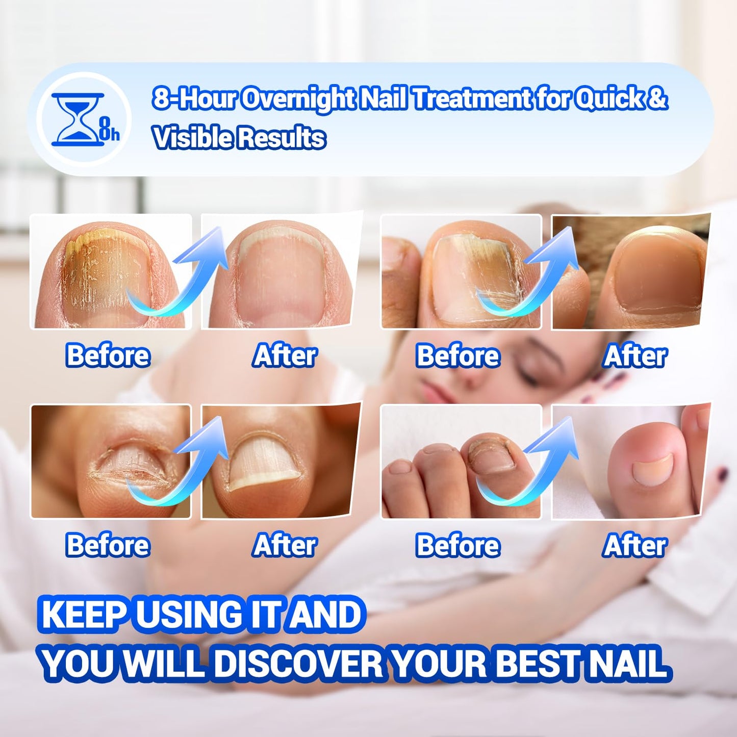 Comfort Toenail Fungus Patches - Extra Strength Hydrogel Overnight Nail Repair (50 Pcs)