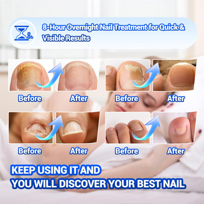 Comfort Toenail Fungus Patches - Extra Strength Hydrogel Overnight Nail Repair (50 Pcs)