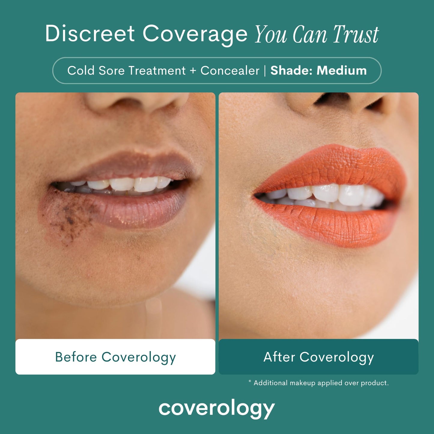 Coverology Cold Sore Treatment & Concealer – Full Coverage Cold Sore Cover-Up