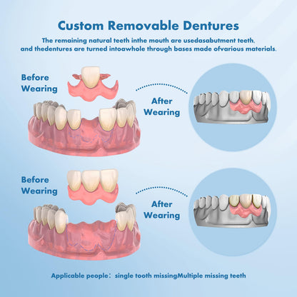 Custom Removable Dentures – Personalized Partial Denture Set with Storage Case | 1–6 Teeth Coverage
