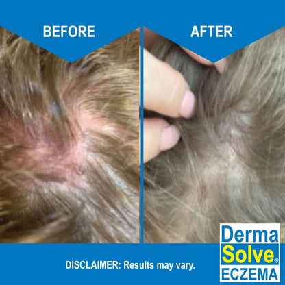 Dermasolve Eczema Relief Shampoo - 2-Pack | Gentle, Fragrance-Free, Non-Steroidal