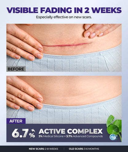 EASEWAVE Silicone Scar Cream with 6.7% Active – Visible in 2 Weeks (55ml)