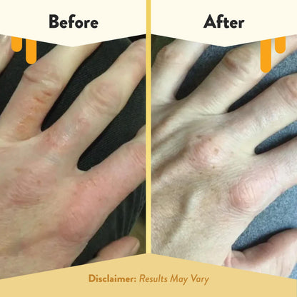 ECZEMA HONEY Oatmeal Hand Cream – Natural Eczema Relief for Dry, Itchy Hands (2 oz)