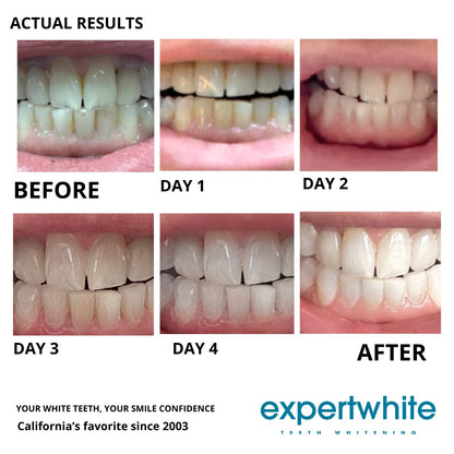 Expertwhite 22% Carbamide Peroxide Teeth Whitening Gel Refills – Made in USA