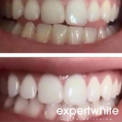 Expertwhite 44% Carbamide Peroxide Teeth Whitening Gel Refills for Trays – 4 x 3cc (15 Minutes)
