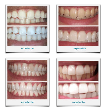 Expertwhite 44% Carbamide Peroxide Teeth Whitening Gel Refills for Trays – 4 x 3cc (15 Minutes)