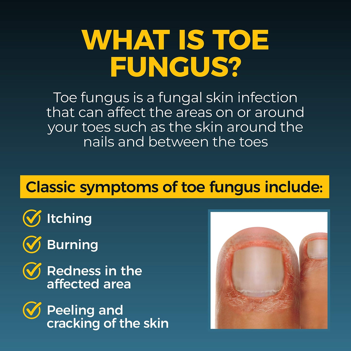 Fungi-Nail Anti-Fungal Liquid Solution – Tolnaftate 1% (Pack of 2, 1 oz Each)