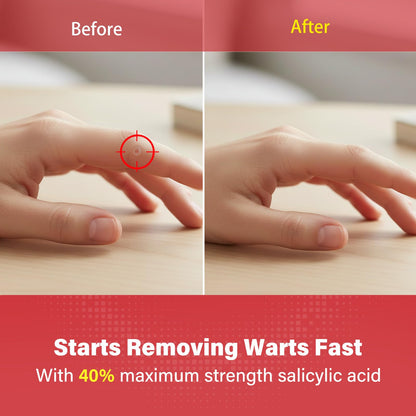Goodnites Wart Remover Pads – Maximum Strength 40% Salicylic Acid, 24-Count, 6 mm & 10 mm Patches for Common & Plantar Warts