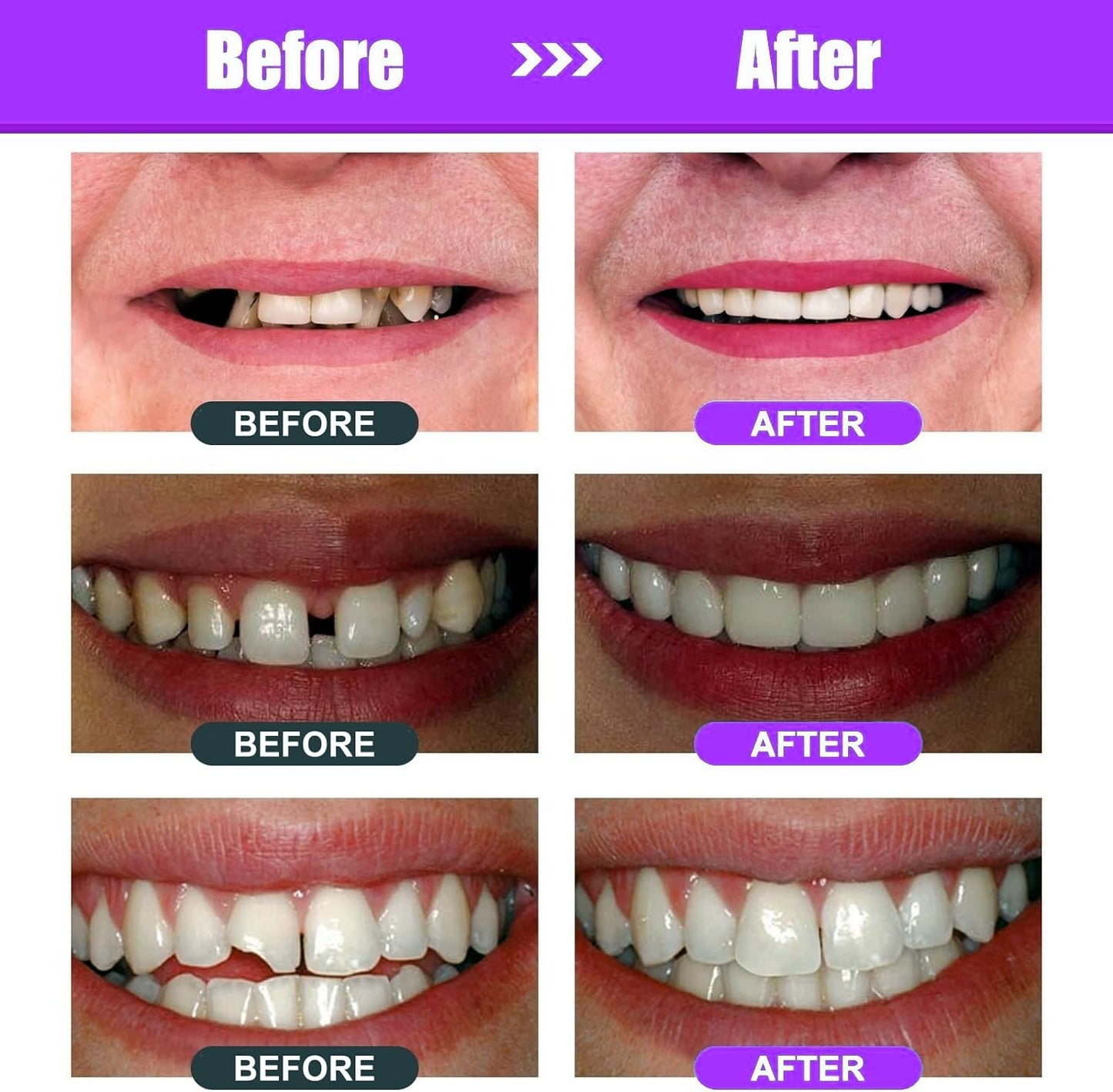 Green Hills Tooth Repair Kit – Moldable Tooth Filling DIY at Home with 4 Dental Tools