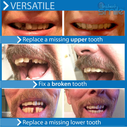 Instant Smile Temporary Tooth Kit -Pro-Series | Realistic, Customizable Tooth Replacement
