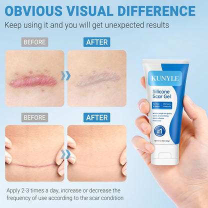 Kunyle Silicone Scar Gel – Advanced Scar Cream for Surgical Scars, Stretch Marks & Keloids (60g)