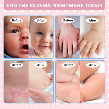LMNOOP Baby Eczema Relief Cream | All-Natural Herbal Formula 3.53oz