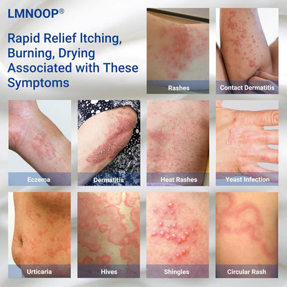 LMNOOP Eczema Cream – Maximum Strength Treatment for Dry, Itchy, Irritated Skin (3.53oz)
