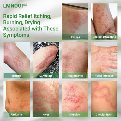 LMNOOP Eczema Cream — Maximum Strength Itch Relief for Dry, Irritated Skin (3.53oz)