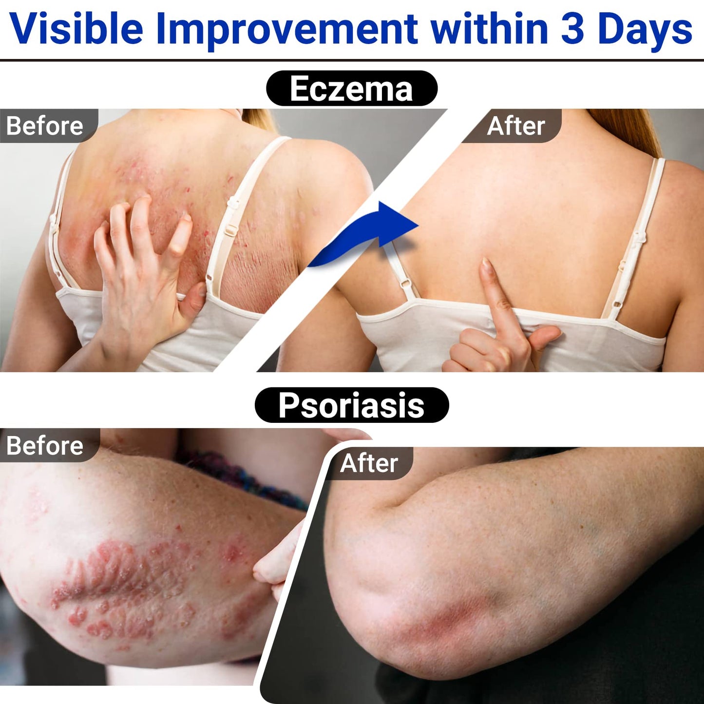 LMNOOP Eczema Cream | Maximum Strength Relief for Itchy, Dry Skin (1.76 oz)