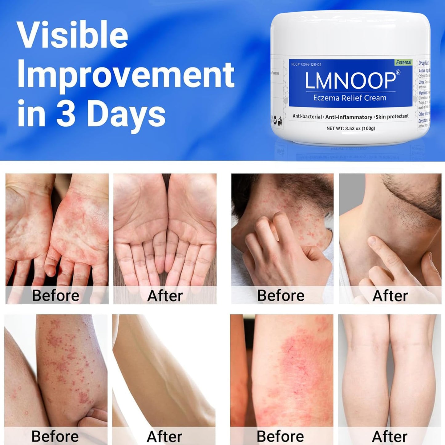 LMNOOP Eczema Cream – Maximum Strength Treatment for Dry, Itchy, Irritated Skin (3.53oz)