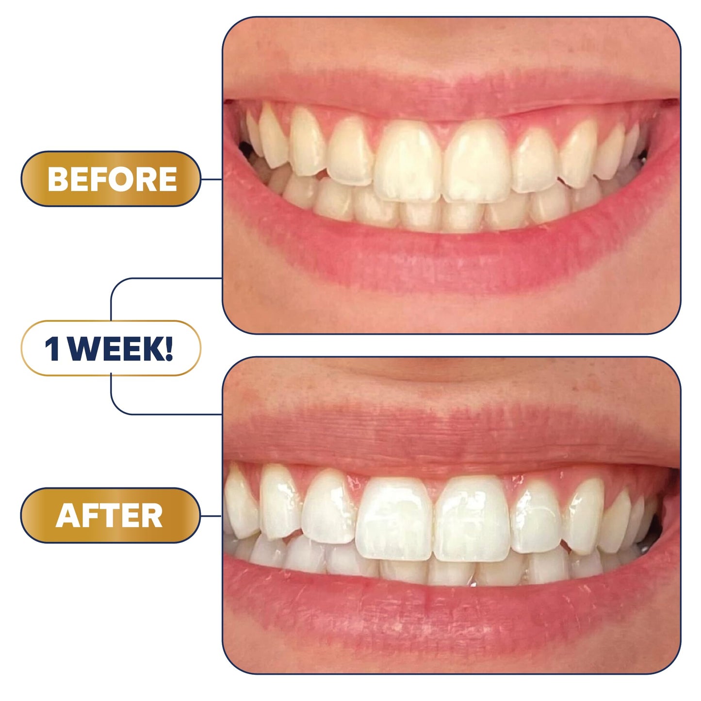 Lumineux Teeth Whitening Strips Kit – 9 Treatments | Peroxide Free, Enamel Safe, Sensitivity Free, Dentist Formulated