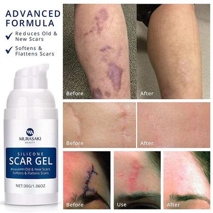 MURASAKI BEAUTY 100% Silicone Scar Gel – Maximum-Strength Scar Cream