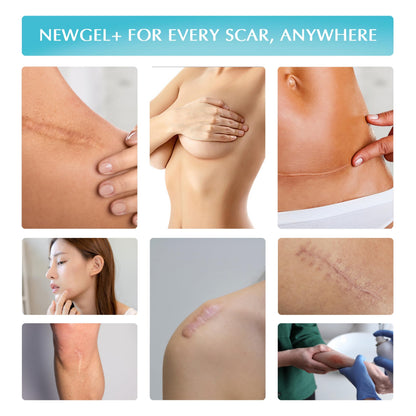 NewGel Plus by MyNewGel – Silicone Scar Gel with Vitamin E (15 g / 0.5 oz)