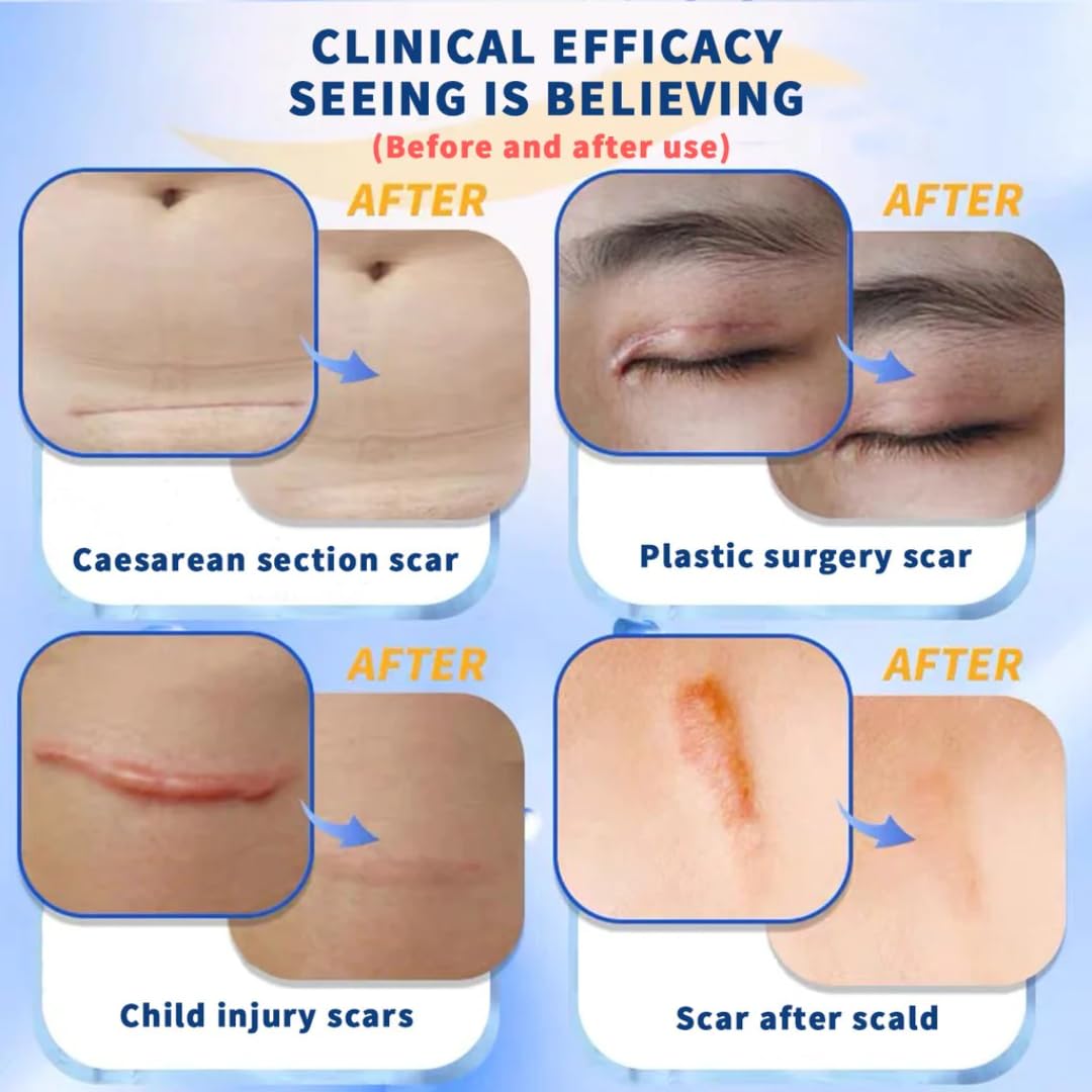 NOUVOS Dermatix Ultra Scar Gel - 15g | Softens and Flattens Scars, Quick-Drying, Odorless
