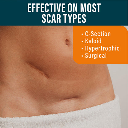 NUVADERMIS Silicone Scar Sheets – Extra Long Medical-Grade, Reusable (Pack of 4) – Dark Tone
