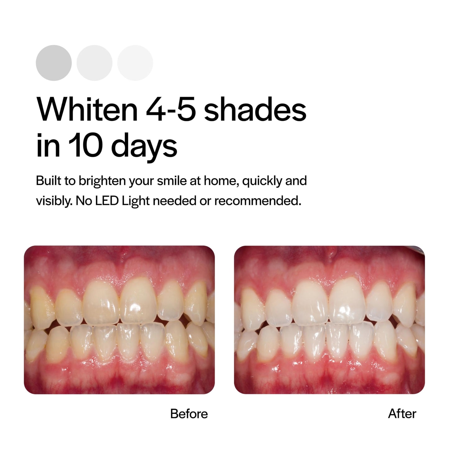 Opalescence Go 15 PF Prefilled Teeth Whitening Trays - 10 Treatments | Ultradent GO15-PF-4638