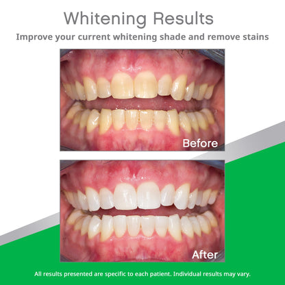 Opalescence Go 10% Prefilled Teeth Whitening Trays Kit – Mint | Ultradent