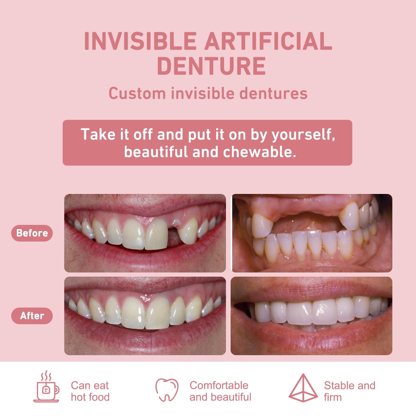 Custom Partial Dentures – Personalized Removable Denture Set for Missing Teeth | 1–6 Tooth Replacement with Storage Case | Natural Look & Comfortable Fit (5 Teeth)