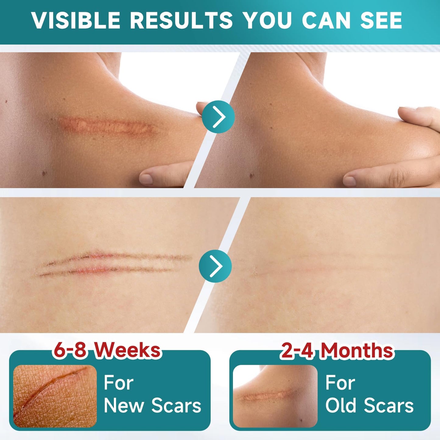 Pumkot Silicone Scar Sheets & Tape – 1.6”x60” Roll for Surgical Scars, C-Section & Burns
